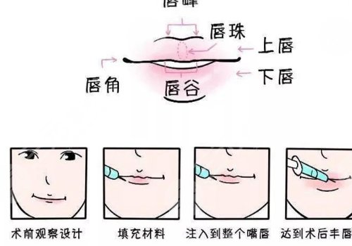 玻尿酸丰唇能维持多久？