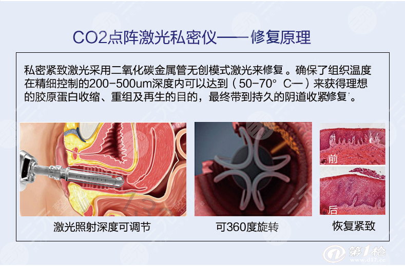 紧缩术