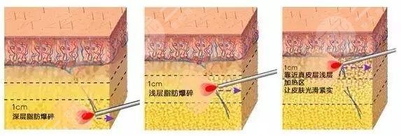 瘦小腿的方法有哪些？