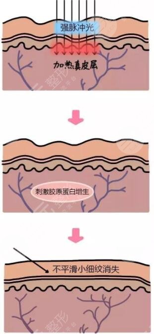 激光收缩毛孔有副作用吗?