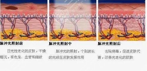 激光收缩毛孔多少钱一次?