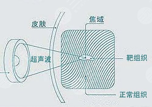 超声炮和热玛吉哪个抗衰老效果好？