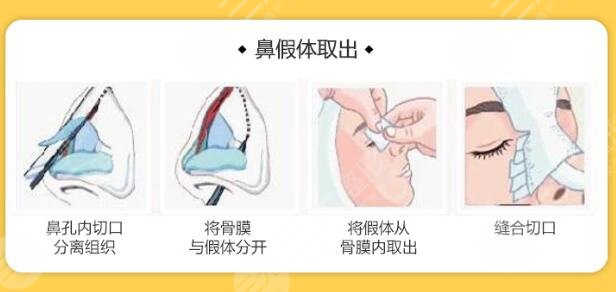 假体隆鼻后护理事项