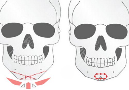 下颌角磨骨有什么后遗症？