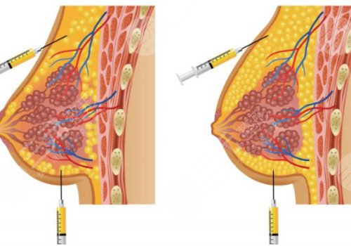 假体隆胸和自体脂肪填充哪个好