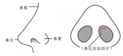 玻尿酸隆鼻有副作用吗?