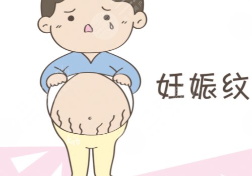 如何消除妊娠纹？