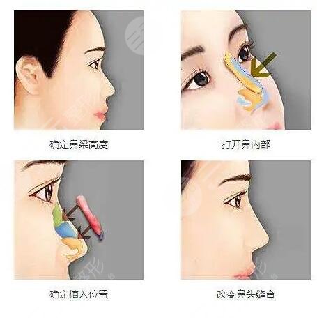 如何预防和治疗膨体隆鼻感染?