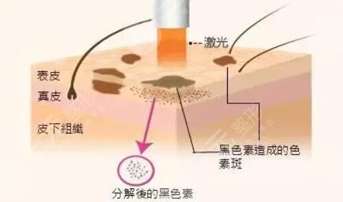 激光祛斑有副作用吗?