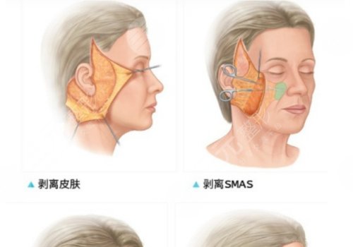 拉皮手术多大年龄做合适？