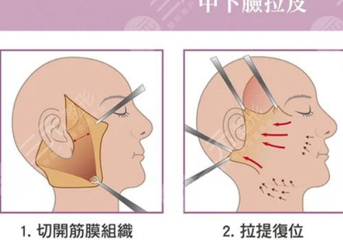 拉皮手术多大年龄做合适？