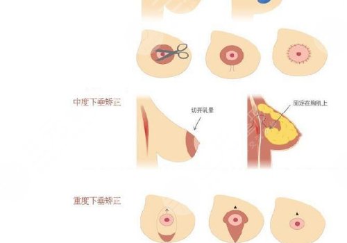 乳房悬韧带提升图片