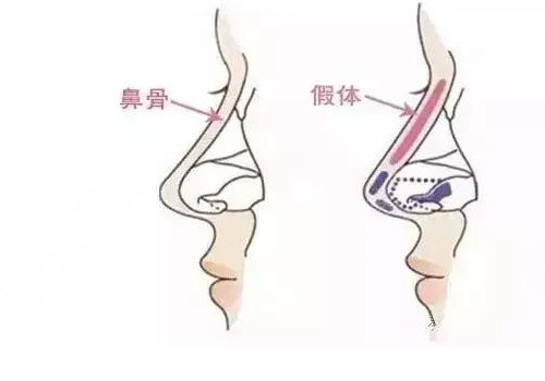 隆鼻假体取出来后能恢复到以前吗？