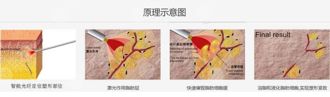 溶脂减肥手术介绍