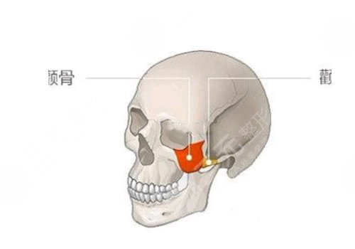 颧骨颧弓内推大概手术费用是多少？