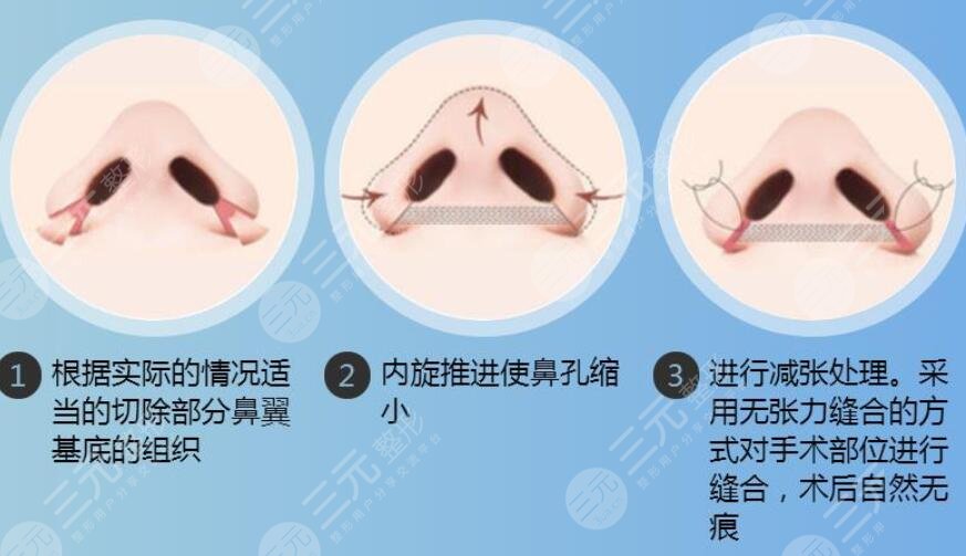 鼻翼缩小手术后如何护理?