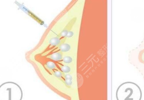 脂肪丰胸效果可以维持多长时间？