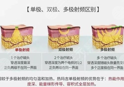 热玛吉有什么效果和副作用？