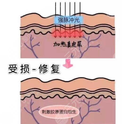 镭射激光嫩肤原理