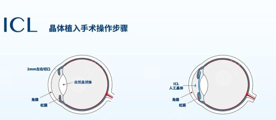 激光手术治疗近视眼的效果及危害是什么?