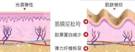 热玛吉紧肤效果怎么样?