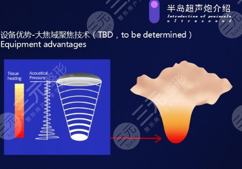 超声炮做一次能维持多长时间？多少钱？