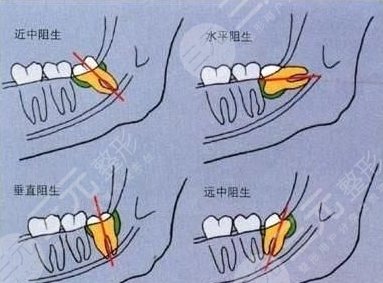 拔智齿后注意事项