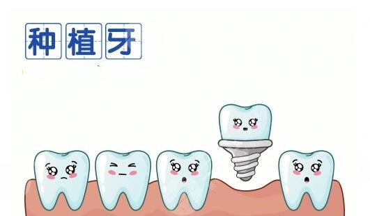 性价比高的种植牙品牌有哪些？登腾、iti、诺贝尔更胜一筹！材料经久耐用~