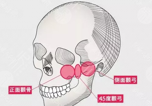 颧弓外扩怎样矫正?外扩原因是什么?