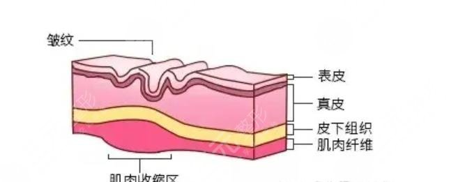 除皱