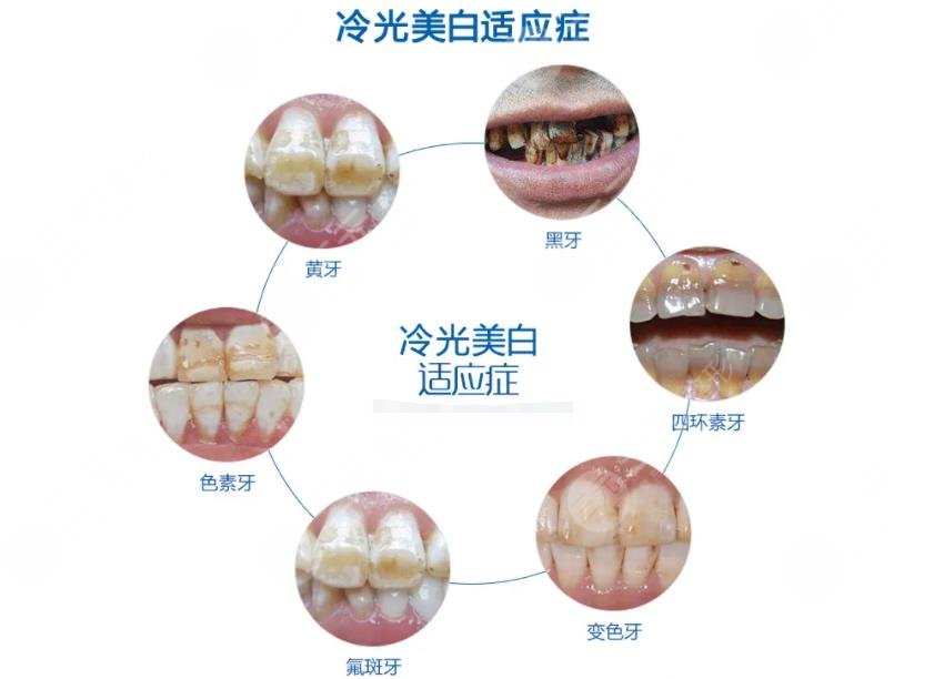 超声波洁牙要多少钱一次?