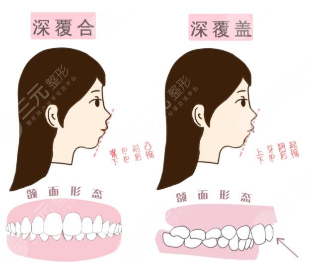 深覆合的矫正年龄是多少?