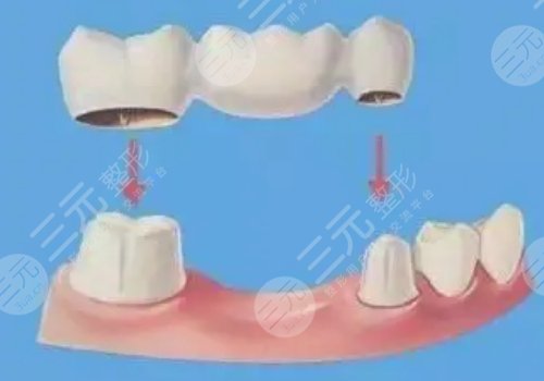 假牙材料有哪几种类型？