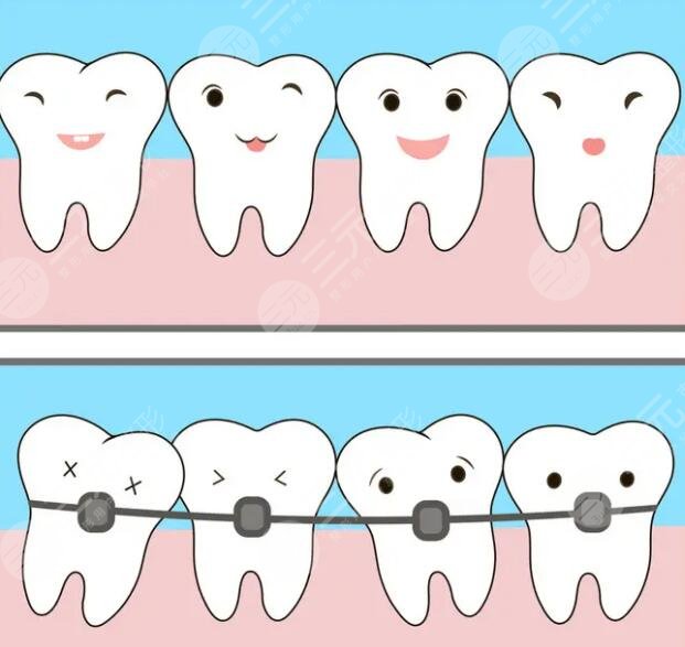 牙齿矫正价格表和方法分别罗列！做牙齿矫正的黄金年纪是多大？多久可以看到结果？