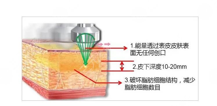 体外超声吸脂是什?么原理?