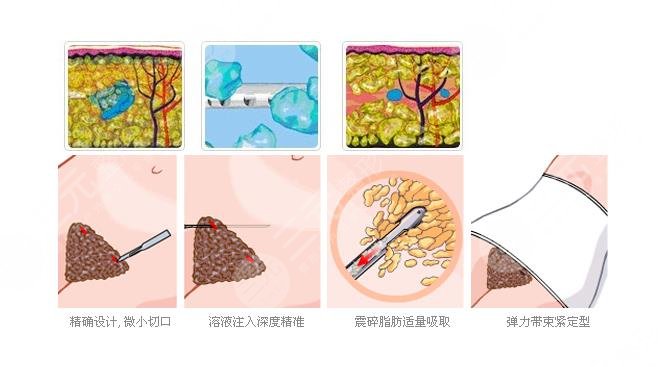 体外超声吸脂是什?么原理?