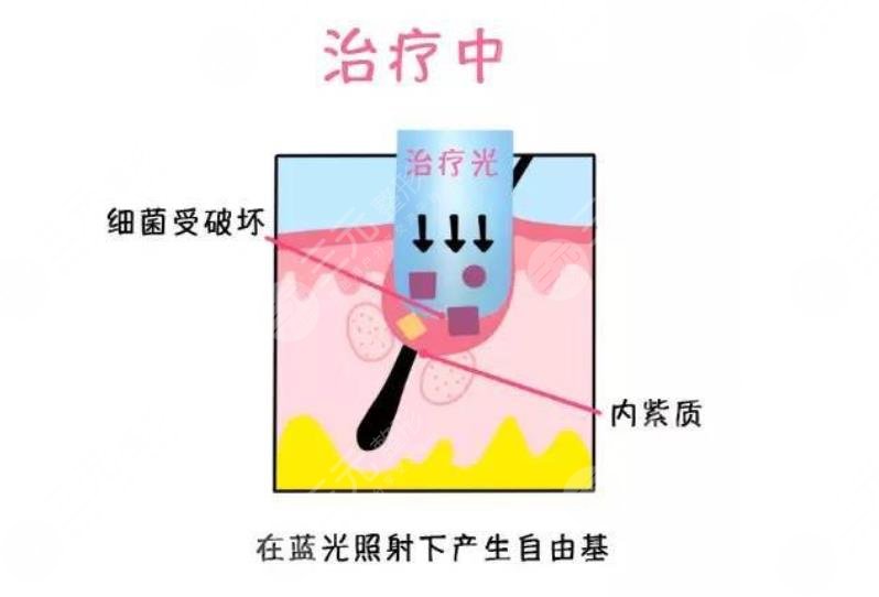 祛痘印痘坑好的方法有哪些？