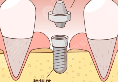 非贵金属烤瓷牙和贵金属烤瓷牙区别