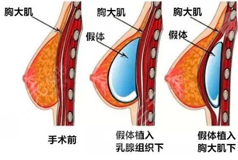 胸部一大一小怎么办？