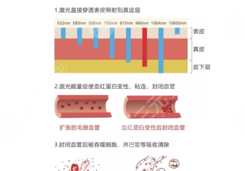 脸上长红血丝怎么去掉