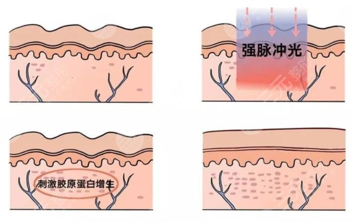 光动力激光治疗有没有副作用？