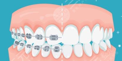 牙齿矫正