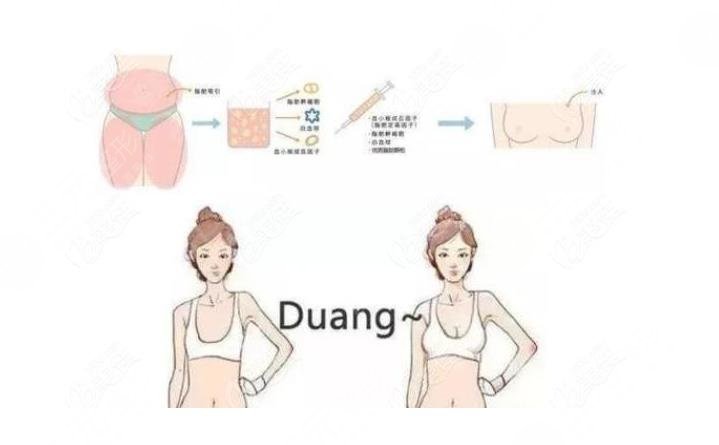 哺乳后丰胸的方法哪个好?