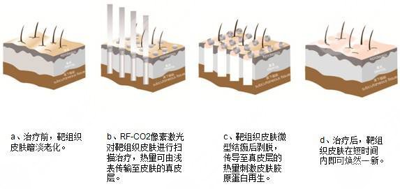 像素激光去痘印有果吗?