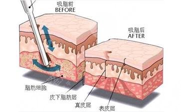 冬季快速减肥的注意事项