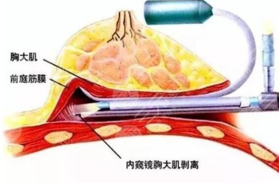 内窥镜假体丰胸有危害吗？