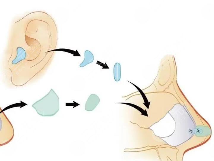 耳软骨隆鼻需要多少钱？
