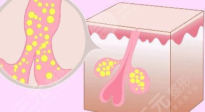 痤疮粉刺是什么原因引起的?