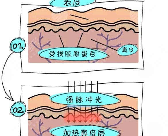 激光美白