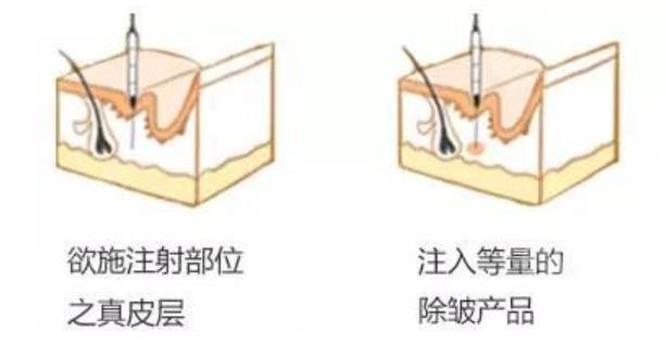 注射除皱